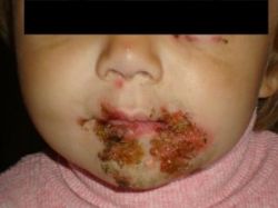 фото ребенка дерматит